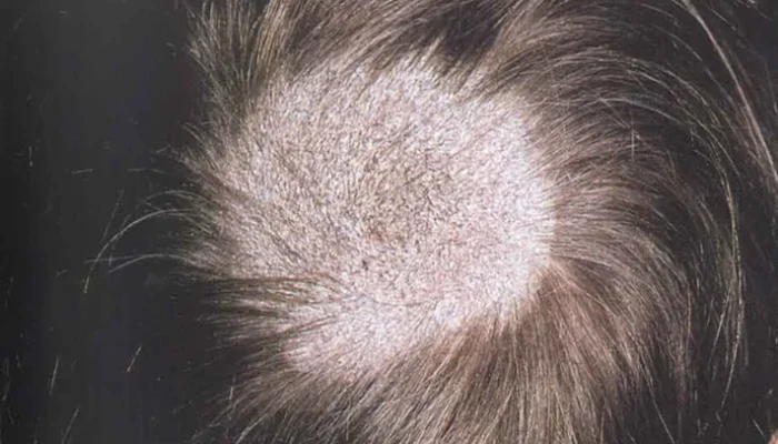 Close up of scalp showing tinea capitis hair loss