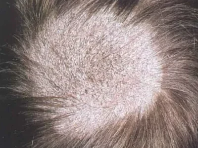 Close up of scalp showing tinea capitis hair loss
